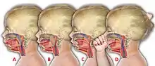  Diagram of tongue thrusting, anterior open bite, glossoptosis, anterior mandibular hypoplasia and adaptive thumb sucking