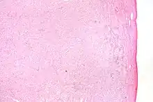 Low magnification micrograph of a thecoma. H&E stain.