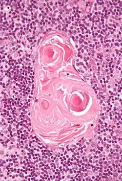 Micrograph showing a Hassall's corpuscle, found within the medulla of the thymus.
