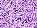 Histopathological image of thymoma type B1. Anterior mediastinal mass surgically resected. Hematoxylin & eosin stain.