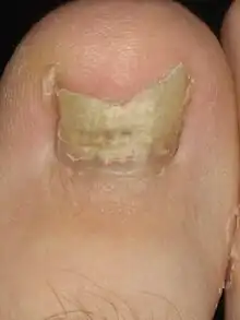 Image 37Onychomycosis (from Fungal infection)
