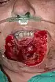 Immediate post-procedure after Mohs surgery resection of lower lip squamous cell carcinoma