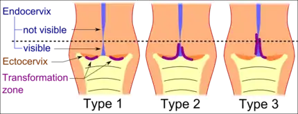 Transformation zone types:Type 1: Completely ectocervical (common under hormonal influence).Type 2: Endocervical component but fully visible (common before puberty).Type 3: Endocervical component, not fully visible (common after menopause).