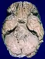 Human brain bottom view. Orbital gyri not labelled, but seen at top.