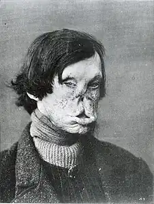 Face deformed by leprosy