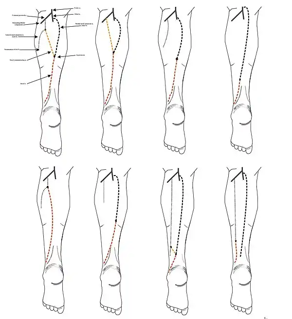 8 documented types of sural nerve formation