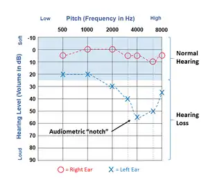 Results of a hearing test plotted on an audiogram illustrating a typical "noise notch" in the left ear