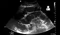 Small bowel obstruction on ultrasound
