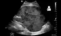 Postoperative bleeding following kidney transplant as seen on ultrasound