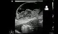 Ultrasound showing an incarcerated umbilical hernia