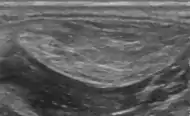 Medical ultrasonography of a lipoma in the thenar eminence: It is hyperechoic compared to adjacent muscle, and relatively well-defined, with miniature hyperechoic lines.