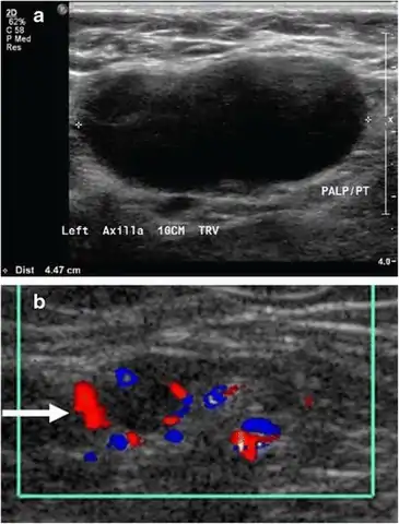 Medical ultrasonography of a soft tissue lump, showing signs of a suspected malignant lymph node:- Doppler ultrasonography that shows hyperaemic blood flow in the hilum and central cortex and/or abnormal (non-hilar cortical) blood flow- Increased focal cortical thickness greater than 3 mm - Absence of the fatty hilum