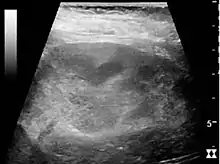 Figure 26. Acute pyelonephritis with increased cortical echogenicity and blurred delineation of the upper pole.