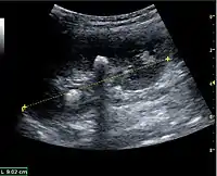 Figure 19. Centrally-located stone with posterior shadowing. No hydronephrosis is present. Measurement of kidney length on the US image is illustrated by ‘+’ and a dashed line.