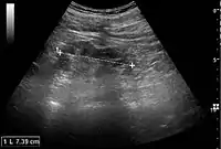 Figure 24. Chronic pyelonephritis with reduced kidney size and focal cortical thinning. Measurement of kidney length on the US image is illustrated by ‘+’ and a dashed line.
