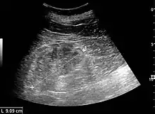 Figure 22. Chronic renal disease caused by glomerulonephritis with increased echogenicity and reduced cortical thickness. Measurement of kidney length on the US image is illustrated by ‘+’ and a dashed line.