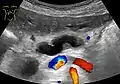 Ultrasonography of a dilated pancreatic duct (in this case 9mm) due to pancreatic cancer.