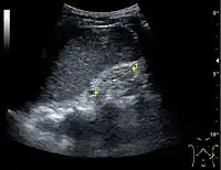 End-stage chronic kidney disease with increased echogenicity, homogenous architecture without visible differentiation between parenchyma and renal sinus and reduced kidney size. Measurement of kidney length on the US image is illustrated by '+' and a dashed line.