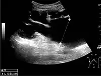 Figure 15. End-stage hydronephrosis with cortical thinning. Measurement of pelvic dilatation on the US image is illustrated by ‘+’ and a dashed line.
