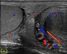 Doppler ultrasound of the scrotum of the same case, in the axial plane, showing orchitis (as part of epididymo-orchitis) as hypoechogenic and slightly heterogenic left testicular tissue (right in image), with an increased blood flow. There is also swelling of peritesticular tissue.