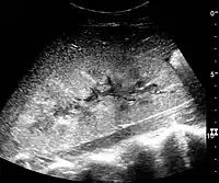 Renal ultrasonograph in renal failure after surgery with increased cortical echogenicity and kidney size. Biopsy showed acute tubular necrosis.