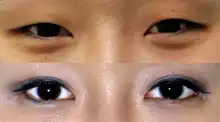 Example of Korean double eyelid surgery