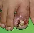 Ingrown toenail before Vandenbos procedure
