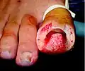 Intraoperative toe (ingrown toenail) during the procedure