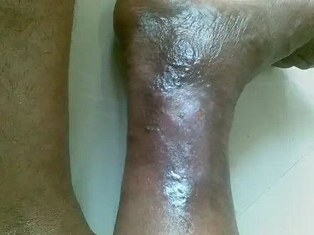 Healing venous ulcer after one month