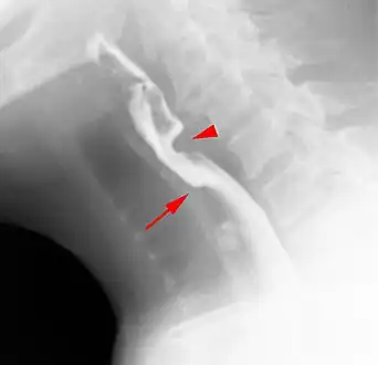Web with "jet-phenomenon". Arrowhead on incomplete opening of the upper esophageal sphincter.