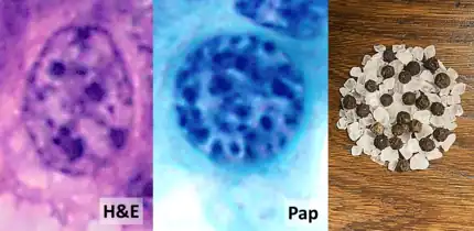 Granular "salt-and-pepper" chromatin.