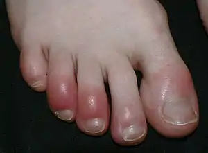 Redness and swelling of the distal toes