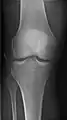 Right knee, anteroposterior