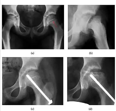 Figure 4: (a) X-ray of a 10-year-old child with left hip pain. It was considered normal at emergency despite the widening of the left physis (arrow). Two weeks later epiphysiolysis was evident (b). Despite appropriate surgical reduction (c) osteonecrosis developed and femoral head collapsed 1 month later (d).