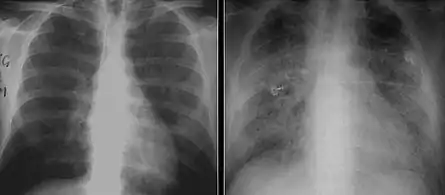 These chest radiographs are of two patients. Both show ground glass opacities. The left X-ray shows a much more subtle ground-glass appearance while the right X-ray shows a much more gross ground-glass appearance mimicking pulmonary edema.