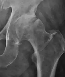 Hip in osteoarthritis