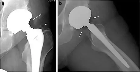 X-ray of a hip with hip replacement and pneumarthrosis, in this case aseptic.