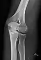 Left elbow by 30 degrees external oblique projection