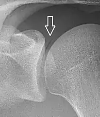 A vacuum sign, or vacuum phenomenon, is a normal finding on shoulder X-rays.