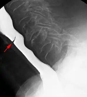Esophageal web stenosis in barium swallow examination lateral view.