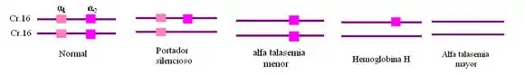 Todos los casos posibles de talasemia alfa, según la ausencia de uno, dos, tres o cuatro genes de la alfa globina
