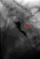 Arteria Sublcavia aberrante mostrada en un estudio de deglución. Impresión del esófago detrás.