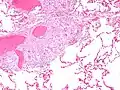 Micrografía de cuerpos de asteroides en sarcoidosis pulmonar. Tinción con hematoxilina eosina.