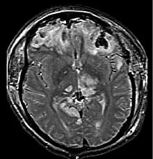 RMN postoperatoria de un paciente con traumatismo craneoencefálico y herniación cerebral resultante.