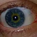 Ojo con heterocromía central azul y amarillo.