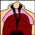 Fisura palatina y labial completa bilateral