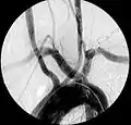 Angiografía mostrando arteria subclavia aberrante derecha