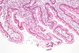 Micrografía mostrando giardiasis en biopsia duodenal.