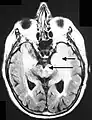 Imagen de RM en secuencia FLAIR que demuestra la infiltración relacionada con el tumor que afecta tanto a los lóbulos temporales (flecha corta) como a la sustancia negra (flecha larga).