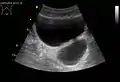 Divertículo de la vejiga urinaria de un hombre de 59 años, plano transversal